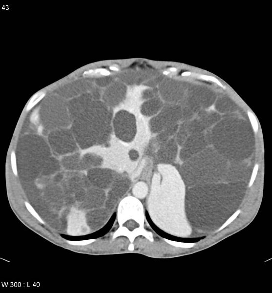 File:Autosomal dominant polycystic kidney disease with extensive hepatic involvement (Radiopaedia 5204-6971 B 3).jpg