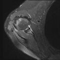 Avulsion fracture - greater tuberosity of humerus (Radiopaedia 71216-81515 Axial PD fat sat 12).jpg