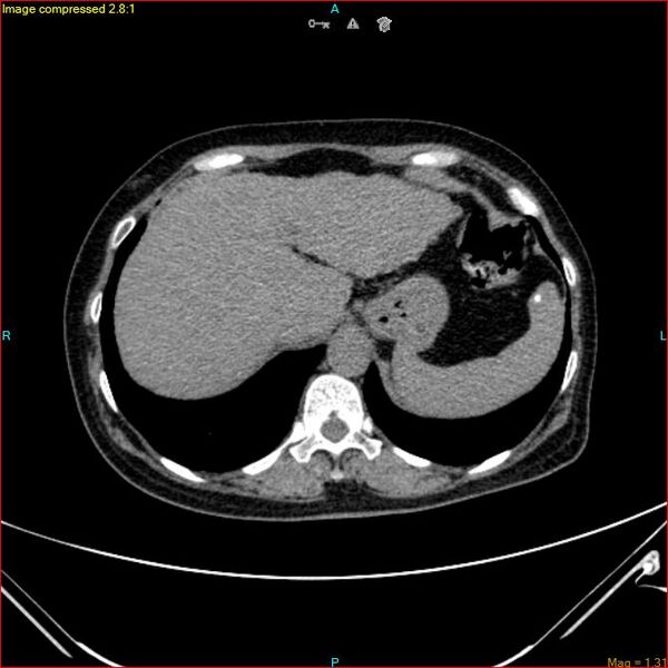 File:Azygos vein aneurysm (Radiopaedia 77824-90130 A 49).jpg