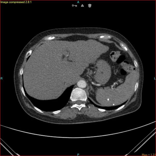 File:Azygos vein aneurysm (Radiopaedia 77824-90130 B 49).jpg