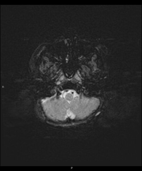 File:Basal ganglia and parenchymal ischemia (Radiopaedia 45818-50084 Axial SWI 4).jpg