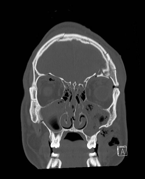 File:Base of skull fracture with bilateral Le Fort fractures (Radiopaedia 47094-51638 Coronal bone window 77).jpg