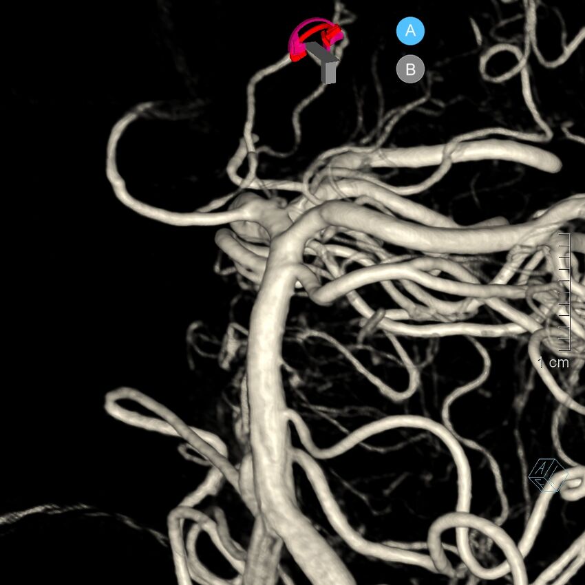 Basilar artery perforator aneurysm (Radiopaedia 82455-97734 3D view left VA 102).jpg