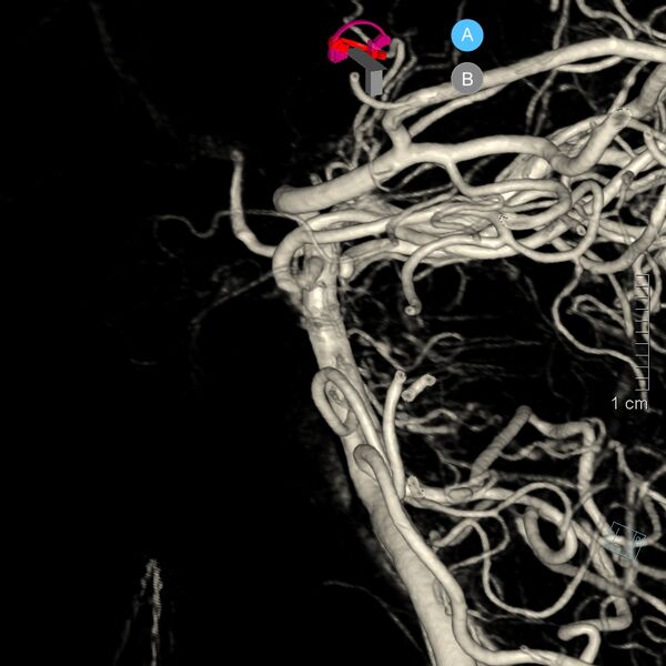 File:Basilar artery perforator aneurysm (Radiopaedia 82455-97734 3D view left VA 15).jpg