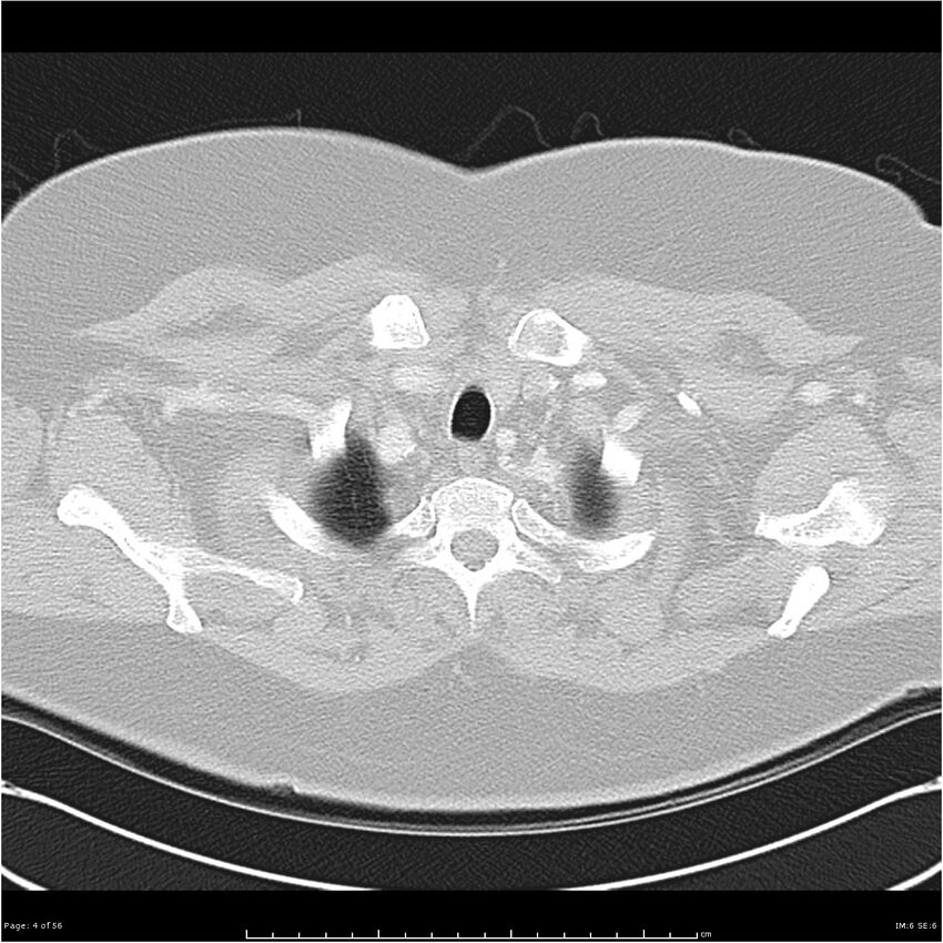 Benign metastasizing leiomyoma (Radiopaedia 26803-26962 Axial lung window 4).jpg
