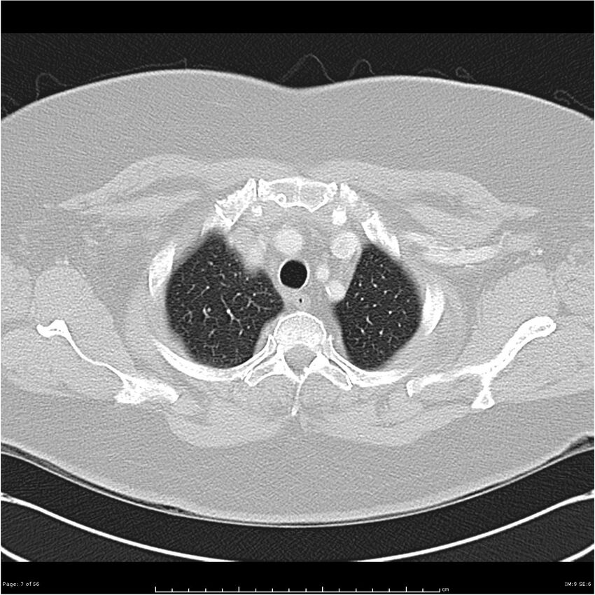 Benign metastasizing leiomyoma (Radiopaedia 26803-26962 Axial lung window 7).jpg