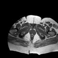 Benign seromucinous cystadenoma of the ovary (Radiopaedia 71065-81300 Axial T1 1).jpg