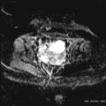 Bicornuate uterus- on MRI (Radiopaedia 49206-54297 Axial ADC 15).jpg