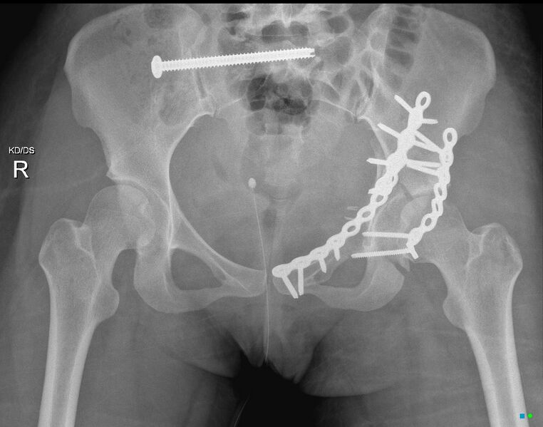 File:Bilateral acetabular fractures (Radiopaedia 79272-92309 Frontal 1).jpg