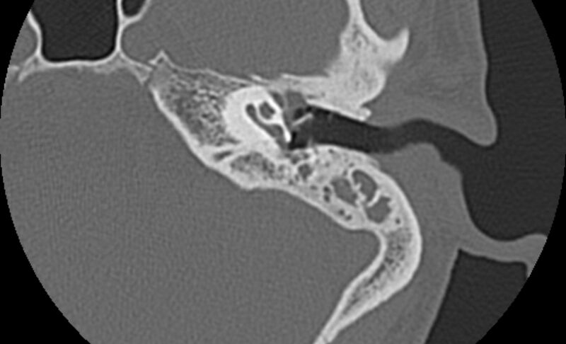 File:Bilateral cholesteatoma (Radiopaedia 54898-61172 C 16).jpg