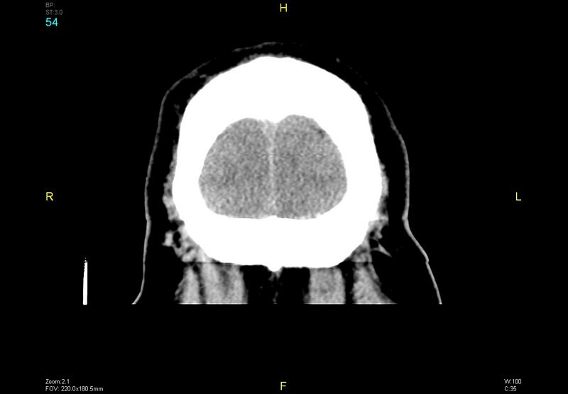 File:Bilateral medial medullary infarction (Radiopaedia 42220-45295 Coronal non-contrast 54).jpg