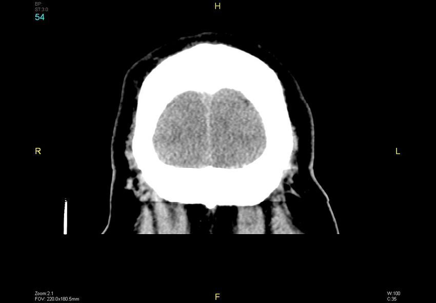 Bilateral medial medullary infarction (Radiopaedia 42220-45295 Coronal non-contrast 54).jpg