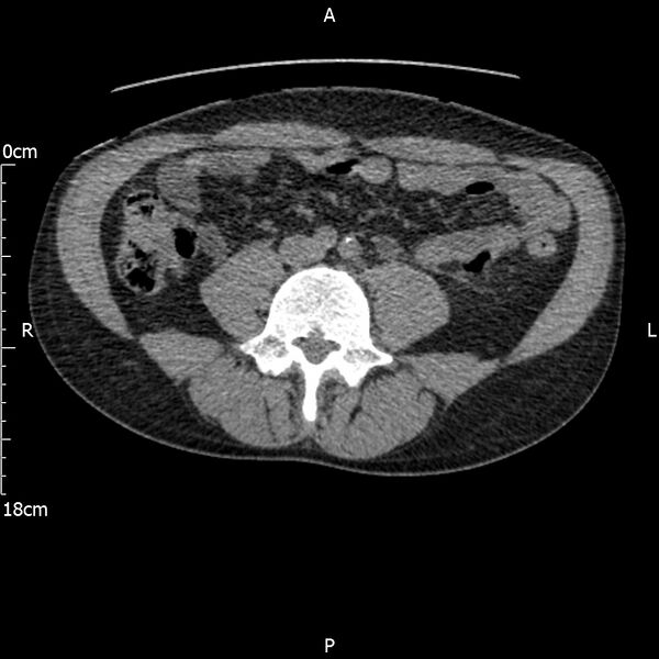 File:Bilateral medullary nephrocalcinosis with ureteric calculi (Radiopaedia 71269-81569 Axial non-contrast 75).jpg