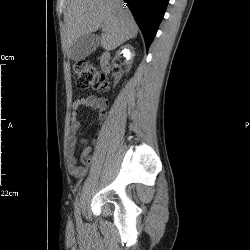 Bilateral medullary nephrocalcinosis with ureteric calculi (Radiopaedia 71269-81569 C 78).jpg