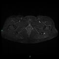 Bilateral ovarian fibroma (Radiopaedia 44568-48293 Axial STIR 30).jpg