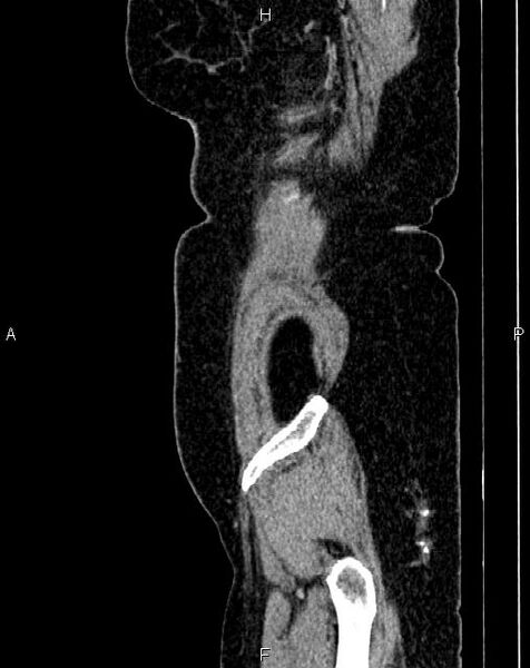 File:Bilateral ovarian serous cystadenocarcinoma (Radiopaedia 86062-101989 E 1).jpg