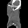 Bilateral perched facets with cord injury (Radiopaedia 45587-49713 B 53).jpg