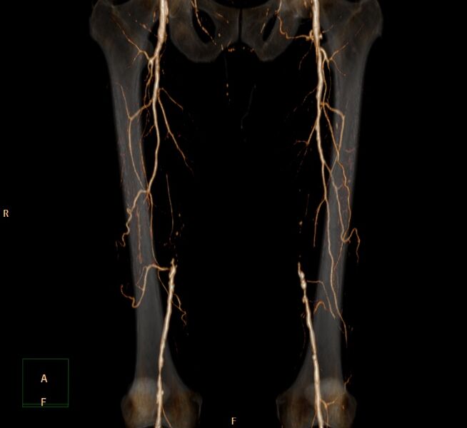 File:Bilateral superficial femoral arterial occlusion (Radiopaedia 25682-25857 3D VR 1).jpg