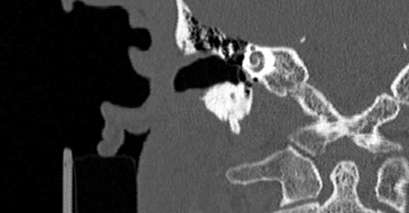 File:Bilateral temporal bone fractures (Radiopaedia 29482-29970 Coronal non-contrast 100).jpg