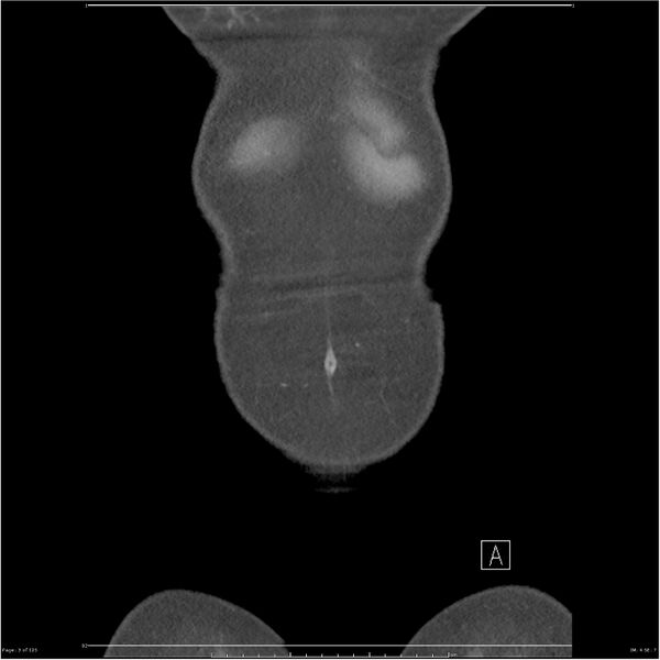 File:Bilateral ureteritis and cystitis (Radiopaedia 25340-25594 B 3).jpg