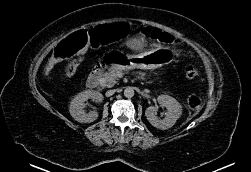 File:Biliary pancreatitis (Radiopaedia 72289-82823 Axial non-contrast 116).jpg