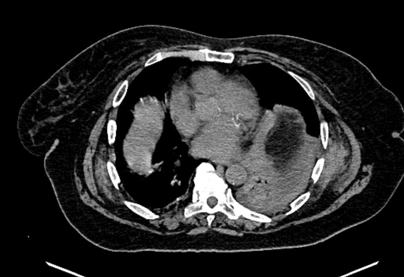 File:Biliary pancreatitis (Radiopaedia 72289-82823 Axial non-contrast 12).jpg