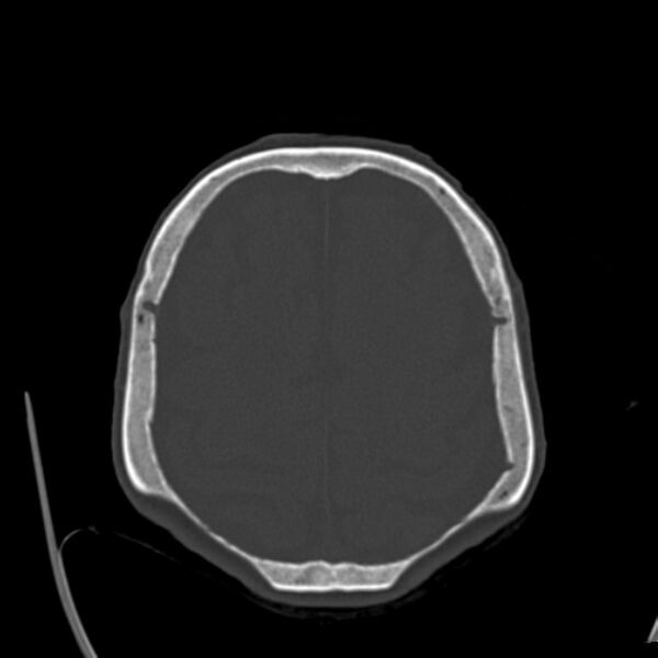 File:Biparietal osteodystrophy (Radiopaedia 46109-50463 bone window 50).jpg