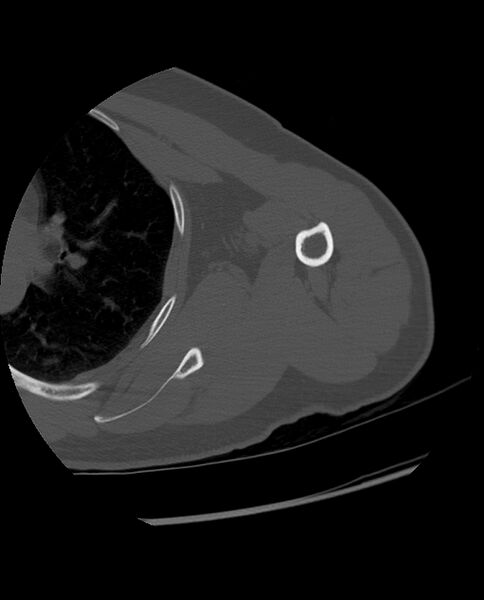 File:Bizarre parosteal osteochondromatous proliferation (Radiopaedia 84221-99501 Axial bone window 21).jpg