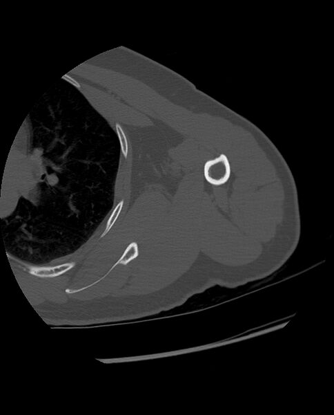 File:Bizarre parosteal osteochondromatous proliferation (Radiopaedia 84221-99501 Axial bone window 24).jpg