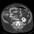 Bladder papillary urothelial carcinoma (Radiopaedia 48119-52951 A 29).png