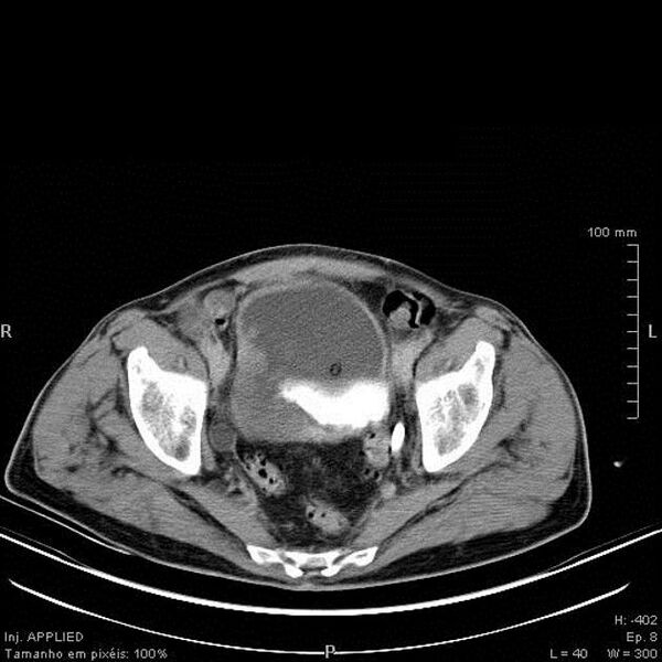 File:Bladder squamous cell carcinoma (Radiopaedia 14130-13984 C 7).jpg