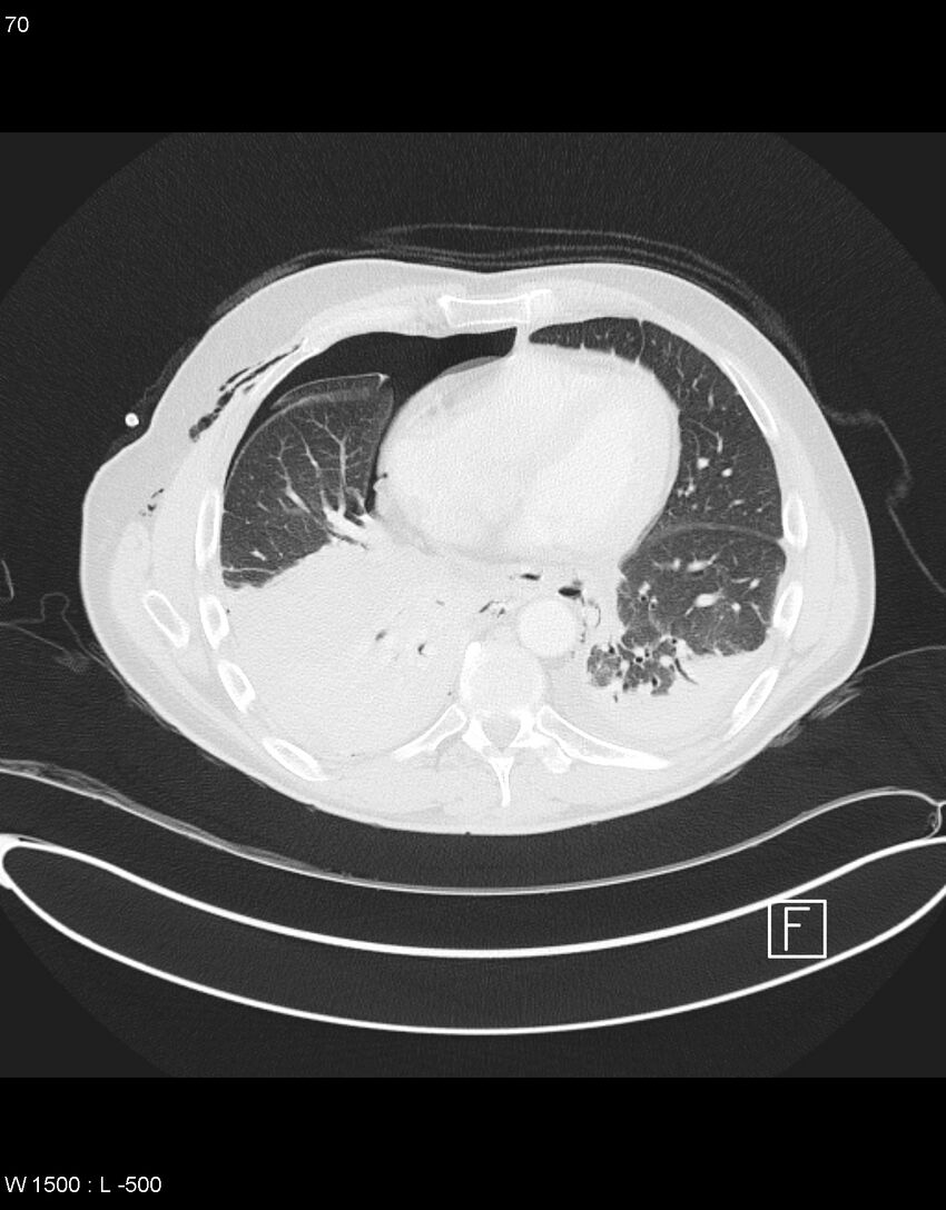 Boerhaave syndrome with tension pneumothorax (Radiopaedia 56794-63605 Axial lung window 34).jpg