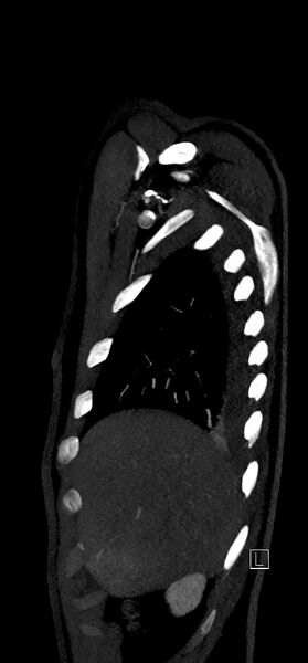File:Brachiocephalic trunk pseudoaneurysm (Radiopaedia 70978-81191 C 16).jpg