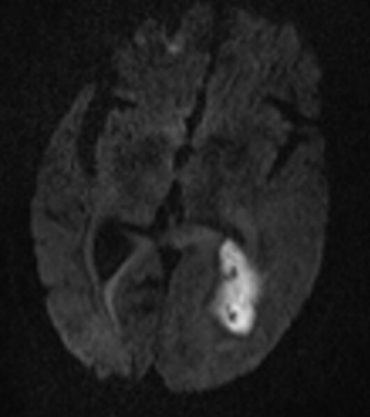 File:Brain abscess with dual rim sign (Radiopaedia 87566-103938 Axial DWI 9).jpg