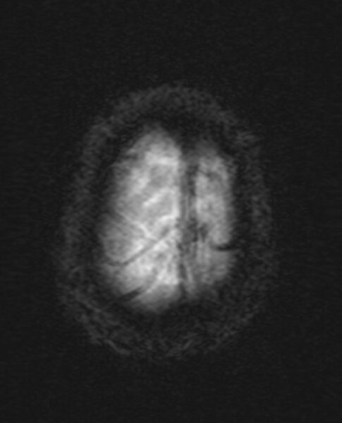 File:Brain abscess with dual rim sign (Radiopaedia 87566-103938 Axial SWI 21).jpg