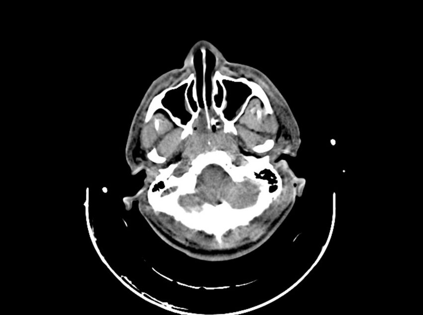 Brain injury by firearm projectile (Radiopaedia 82068-96087 B 49).jpg