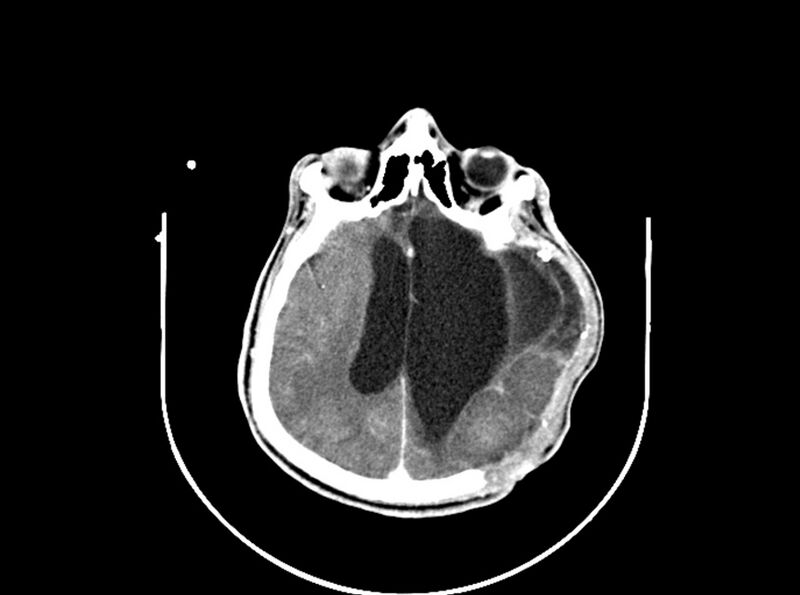 File:Brain injury by firearm projectile (Radiopaedia 82068-96088 B 139).jpg