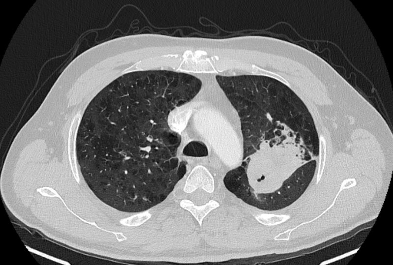 File:Brain metastases - lung cancer primary (Radiopaedia 75060-86116 Axial lung window 14).jpg