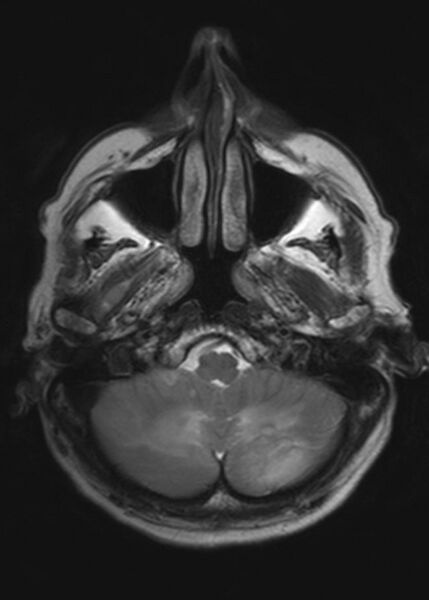 File:Brain metastases from squamocellular lung cancer (Radiopaedia 56515-63222 Axial T2 5).jpg