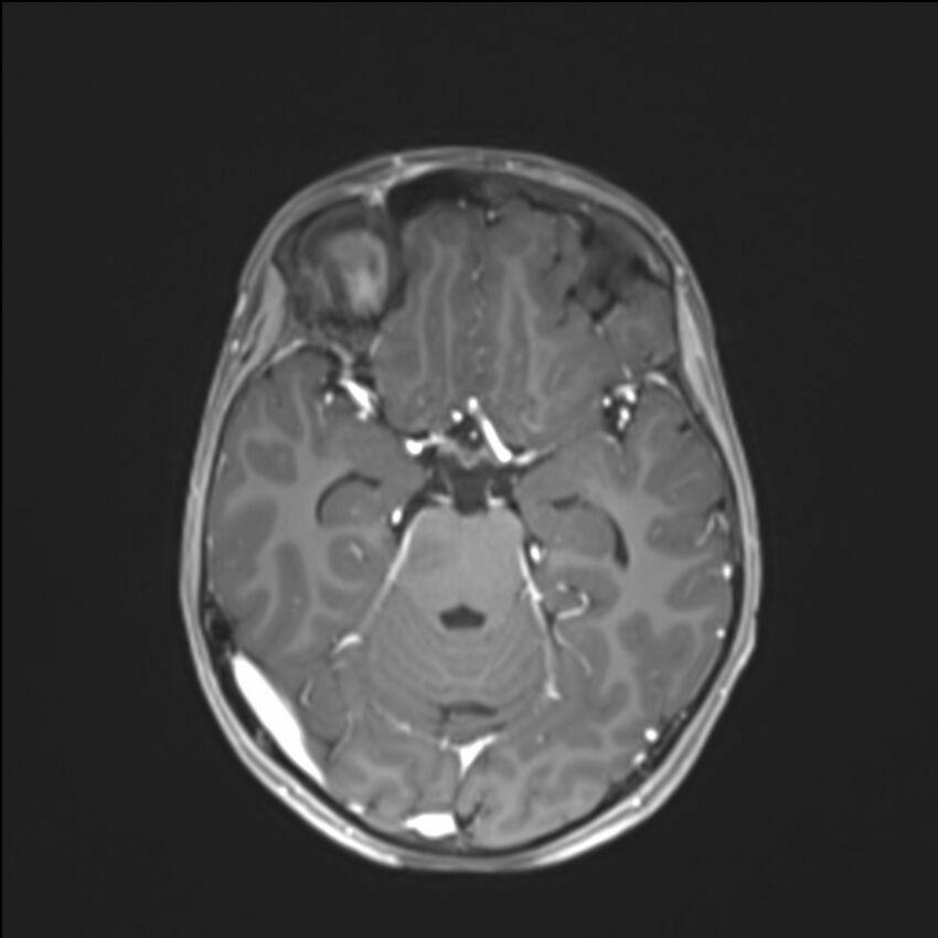 Brainstem glioma (Radiopaedia 70548-80674 Axial T1 C+ 65).jpg