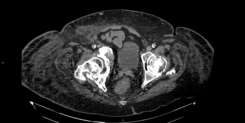 File:Breast cancer pelvic bony metastases (Radiopaedia 84470-99824 Axial bone window 57).jpg