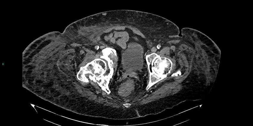 Breast cancer pelvic bony metastases (Radiopaedia 84470-99824 Axial bone window 57).jpg