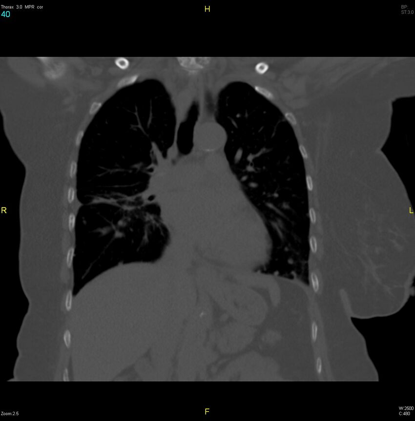 Breast primary with lung and bone metastases (Radiopaedia 40620-43228 bone window 40).jpg