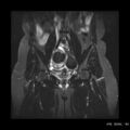 Broad ligament fibroid (Radiopaedia 49135-54241 Coronal STIR 13).jpg
