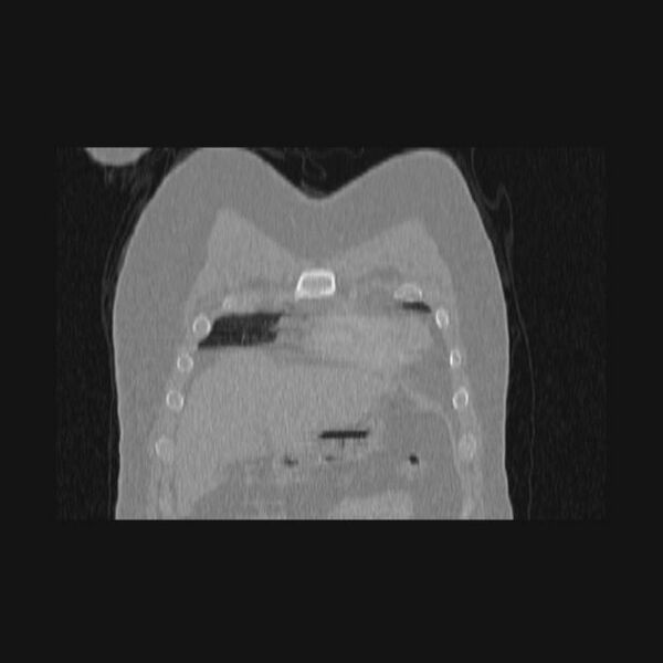 File:Bronchial atresia (Radiopaedia 60685-68439 Coronal lung window 68).jpg
