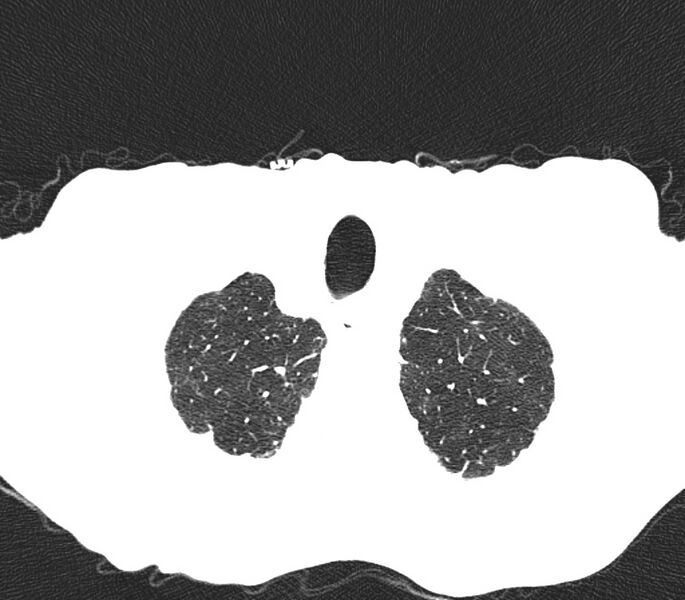 File:Bronchiolitis (Radiopaedia 24616-24887 Axial lung window 1).jpg