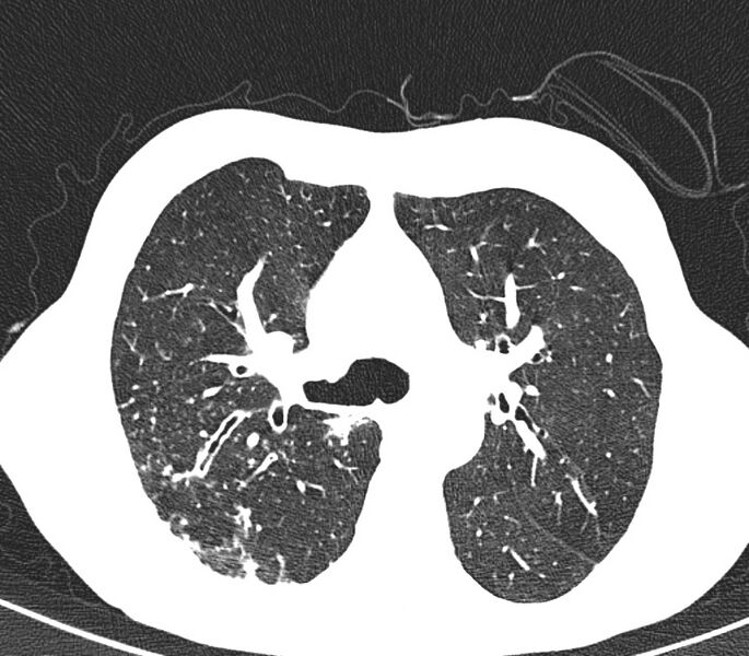File:Bronchiolitis (Radiopaedia 24616-24887 Axial lung window 18).jpg