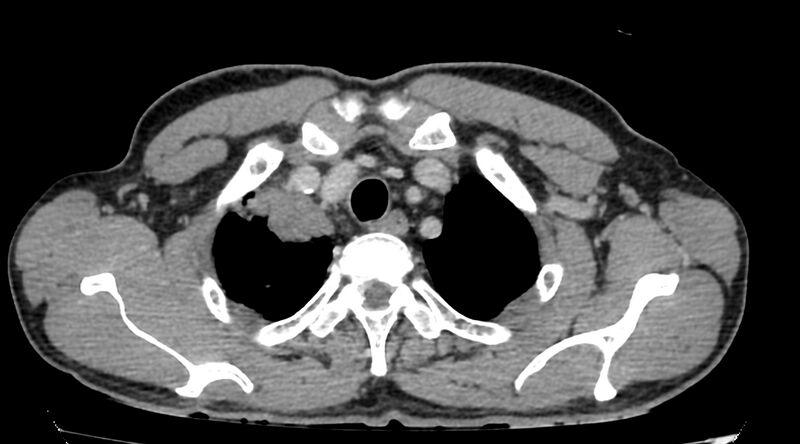 File:Bronchogenic carcinoma with superior vena cava syndrome (Radiopaedia 36497-38054 Axial C+ delayed 6).jpg
