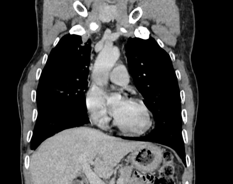 File:Bronchogenic carcinoma with superior vena cava syndrome (Radiopaedia 36497-38054 Coronal C+ delayed 12).jpg