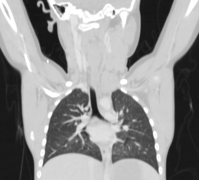 File:Bronchus suis (Radiopaedia 68131-77620 Coronal lung window 9).jpg